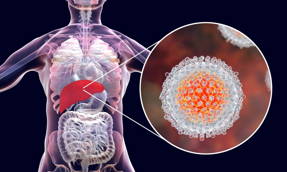 Hepatites
