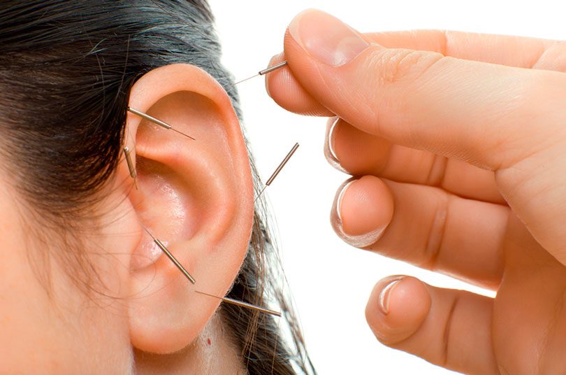 Auriculoterapia