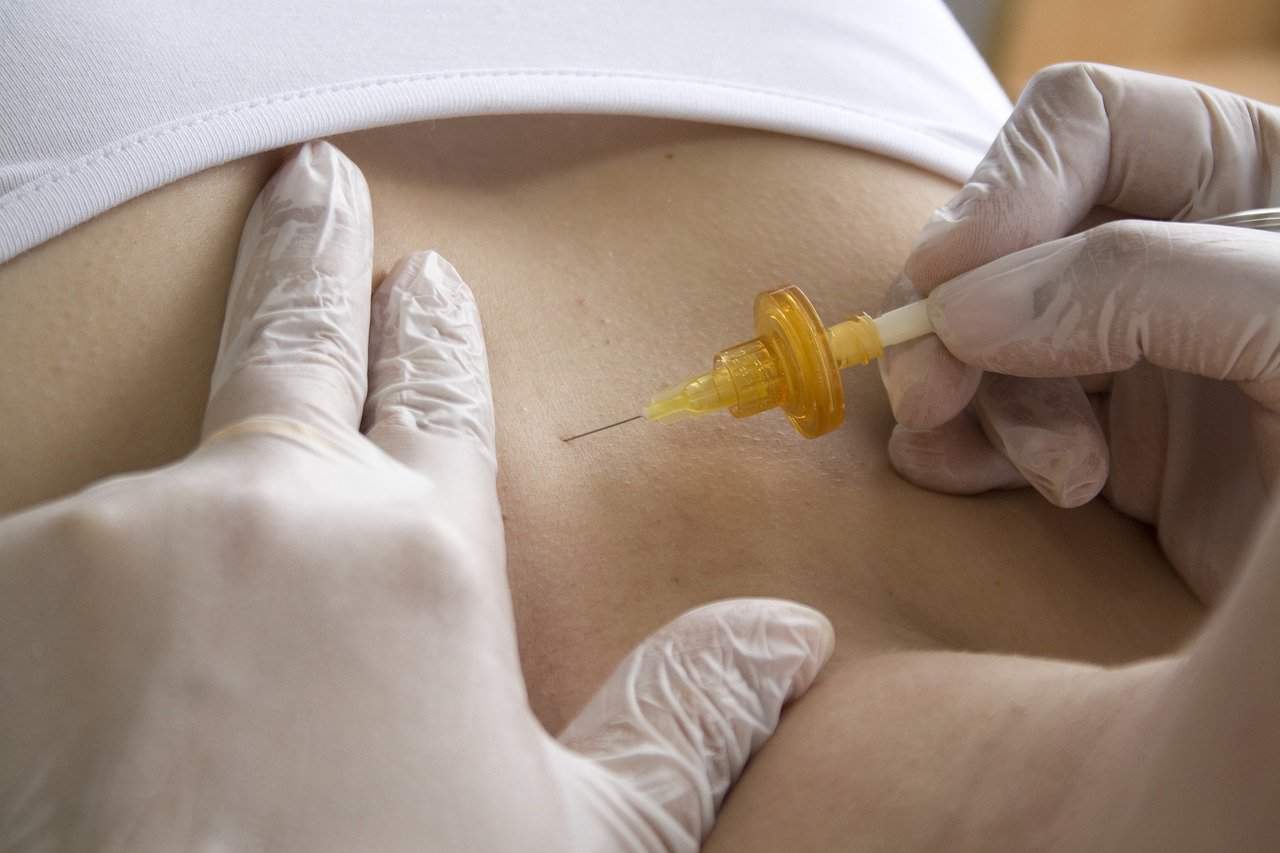 Carboxiterapia
